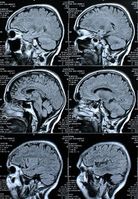 Gehirne im Querschnitt: Informationsfluss kompliziert Bild: pixelio.de, Rike