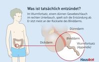 Nicht der Blinddarm selbst, sondern der Wurmfortsatz, ein Anhängsel an seiner Rückseite, ist bei einer Entzündung betroffen. Grafik: obs/HausArzt-PatientenMagazin