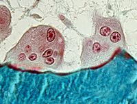 Feingeweblicher Schnitt vom Knochen eines Patienten. Zu sehen sind zwei Osteoklasten (mehrkernige Zellen), die den Knochen (hier blau) gerade zerstören. Foto: UKE