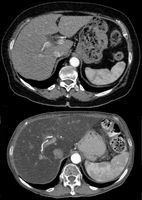 Ausgeprägte Fettleber in der Computertomographie (unten) im Vergleich zu einer normalen Leber (oben).