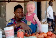 Die Vierjährige hat Albinismus. Bild: CBM Fotograf: Anthony Atiko