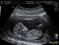 Sonografische Aufnahme eines Fetus mit 12 Schwangerschaftswochen