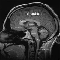 MRT-Bild eines menschlichen Gehirns. Schnitt sagittal, die Nase ist links.