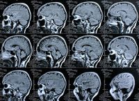 Gehirn-Scans: Heilung von Schädigungen als Ziel. Bild: pixelio.de, Rike