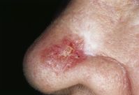 Heller Hautkrebs: Sklerodermiformes Basaliom (Morphea-Basaliom)[
