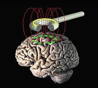 Schematische Darstellung der transkraniellen Magnetstimulation.