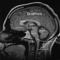 MRT-Bild eines menschlichen Gehirns. Schnitt sagittal, die Nase ist links. Hier klicken für eine animierte Abfolge von Schnitten.