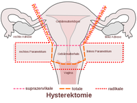 Schematische Darstellung der Ausdehnung unterschiedlicher Formen der Hysterektomie