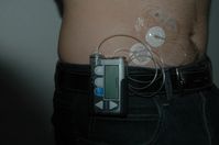 Insulinpumpe mit Infusionsset