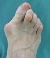 Hallux valgus