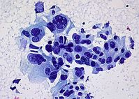 Krebszellen: Genom könnte Schätze enthalten. Bild: Flickr/Uthman