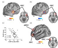 Die Abbildung zeigt verschiedene Kartogramme zum Volumen-Vergleich der grauen Masse (GMV) im orbitofrontalen Kortex (OFC) sowie ein Korrelationsdiagramm. Bild: Universität Ulm