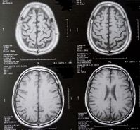 Gehirn-Scans: neue Erkenntnisse bei ALS.