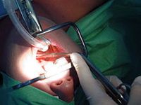 Tonsillektomie bezeichnet die vollständige chirurgische Entfernung der Gaumenmandeln (tonsilla palatina). Die Tonsillektomie ist der häufigste Routineeingriff im operativen HNO-Bereich und eine der am häufigsten durchgeführten geplanten Operationen überhaupt. Bild: Welleschik / wikipedia.org