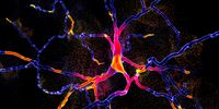 Darstellung degenerierter Nervenzellen, eine Schlüsselentwicklung der Parkinson-Krankheit