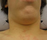 Lymphknotenschwellung und Hautausschlag bei Infektiöser Mononukleose