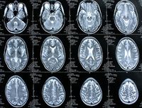 Gehirn-Scans: deutlich mehr Tumore bei Akademikern. Bild: pixelio.de, Rike