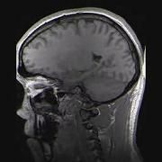 MRT-Aufnahme eines menschlichen Kopfes in sagittaler Schnittebene Bild: Structural.gif / de.wikipedia.org