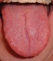 Zunge des Menschen. Das Bild zeigt einen Sonderbefund, nämlich eine Faltenzunge (Lingua plicata).