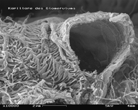 REM-Bild eines Glomerulus mit gebrochener Blutkapillare