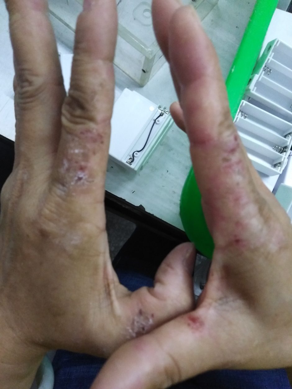 Allergische Hautreaktionen wegen fehlender Handschuhe beim Umgang mit Chemikalien in der Fabrik Dongyao Bild: China Labor Watch